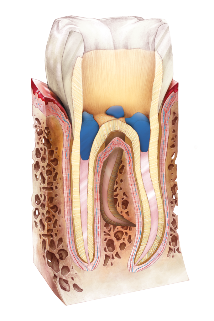 Oznaczanie i zabezpieczanie ujść kanałów po leczeniu endodontycznym